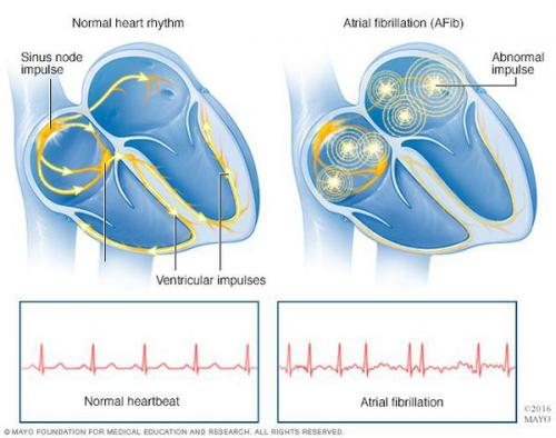 Кофеин предотвращает развитие фибрилляции предсердий. Кофе и алкоголь оказались главными пусковыми факторами мерцательной аритмии 01