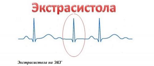 Как убрать аритмию без лекарств. Аритмия в состоянии покоя 01