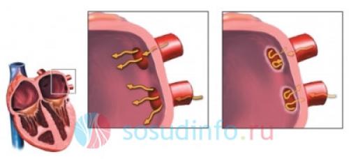 Абляция сердца последствия. Виды абляции сердца