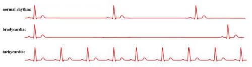 Что нельзя при аритмии сердца. Определение болезни. Причины заболевания 01
