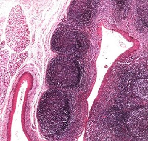 Казеозные пробки выходят сами. От чего образуются пробки в горле