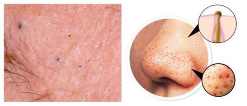 Как убрать следы от прыщей на лице. Симптомы постакне 03