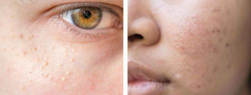 Как убрать следы от прыщей на лице. Симптомы постакне 02