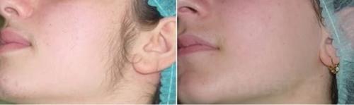 Сколько надо процедур лазерной эпиляции. Количество процедур 05 Сколько надо процедур лазерной эпиляции. Количество процедур 05