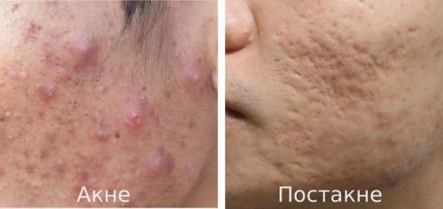 Как избавиться от покраснений после прыщей. Как действуют профессиональные косметологические методики 04