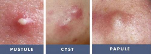 Как избавиться от покраснений после прыщей. Как действуют профессиональные косметологические методики 05