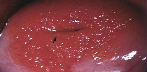 Что такое эрозия. Эрозия шейки матки, что это такое?