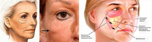 Какими процедурами можно убрать мешки под глазами на скулах. Что такое малярные мешки?