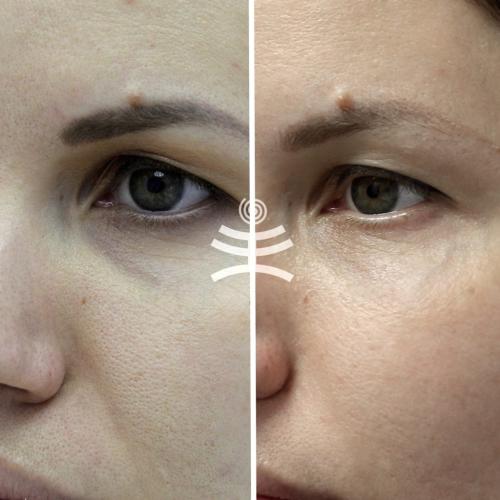 Морщина под глазом. Все способы избавиться от морщин вокруг глаз