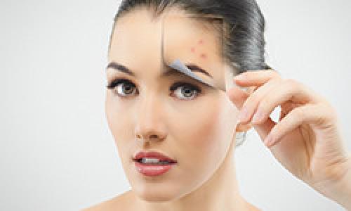 Самые эффективные средства от прыщей на лице у подростков. Чистая кожа раз и навсегда! Как победить акне?