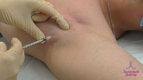 Побочка от Ботокса в межбровье. Побочные эффекты после Ботокса 02 Побочка от Ботокса в межбровье. Побочные эффекты после Ботокса 02