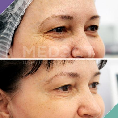 Морщины на веках под бровями, что делать. Все способы избавиться от морщин вокруг глаз