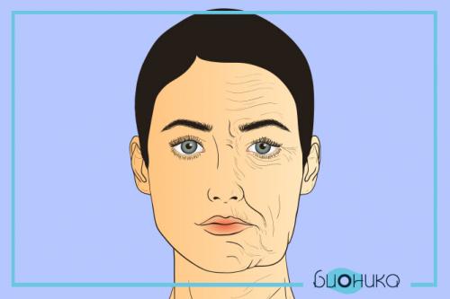 Побочка от Ботокса в межбровье. Побочные эффекты после Ботокса 07 Побочка от Ботокса в межбровье. Побочные эффекты после Ботокса 07