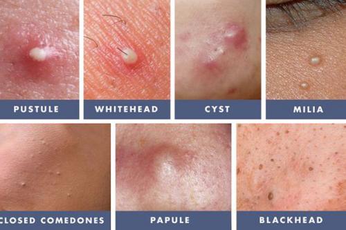 Убрать пятна после прыщей на лице. Как убрать постакне? 07 Убрать пятна после прыщей на лице. Как убрать постакне? 07