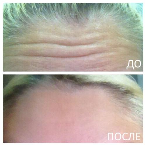 Куда колят ботокс на лице схема до и после. Куда колят Ботокс? 04