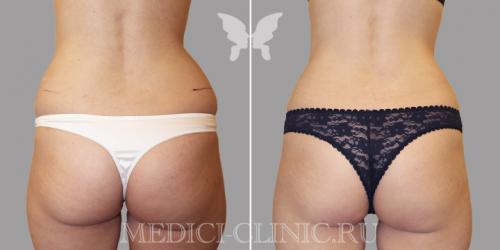 Жировые ловушки на теле у женщины, как избавиться. Методы устранения локальных жировых отложений 03