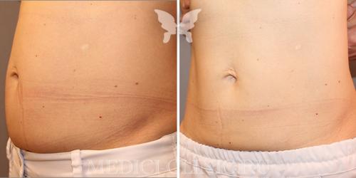 Жировые ловушки на теле у женщины, как избавиться. Методы устранения локальных жировых отложений 04