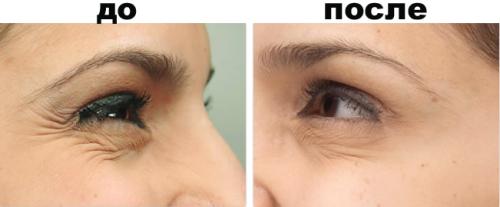 Как убрать гусиные лапки вокруг глаз