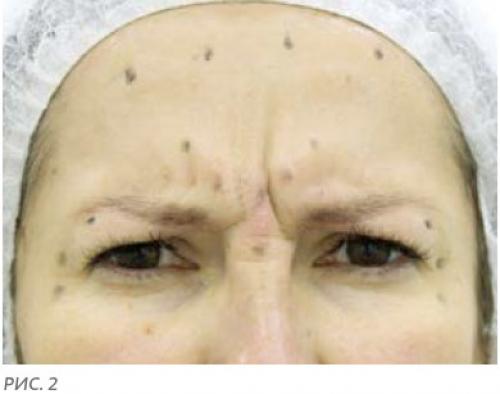 Инъекции Ботокс в лоб. Куда колят Ботокс? 03 Инъекции Ботокс в лоб. Куда колят Ботокс? 03