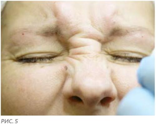 Инъекции Ботокс в лоб. Куда колят Ботокс? 06 Инъекции Ботокс в лоб. Куда колят Ботокс? 06