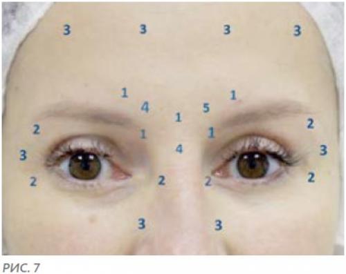 Инъекции Ботокс в лоб. Куда колят Ботокс? 08 Инъекции Ботокс в лоб. Куда колят Ботокс? 08