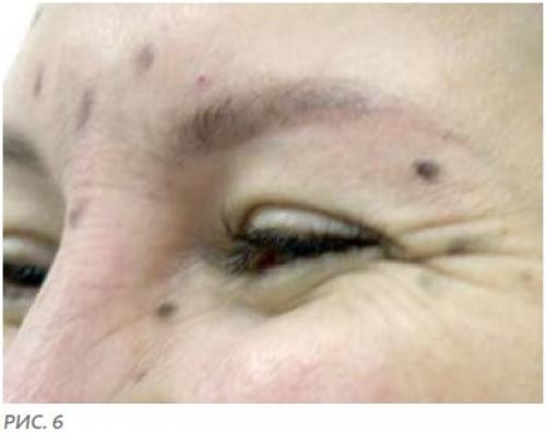 Инъекции Ботокс в лоб. Куда колят Ботокс? 07 Инъекции Ботокс в лоб. Куда колят Ботокс? 07