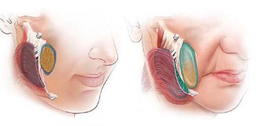 Проблемы нижней трети лица. Первые признаки птоза лица 01