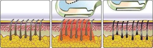 Подготовка к лазерной эпиляции глубокого бикини. Особенности удаления волос в интимной зоне