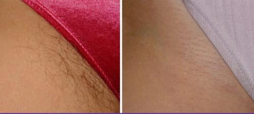 Как часто ходить на лазерную эпиляцию бикини. Описание процедуры