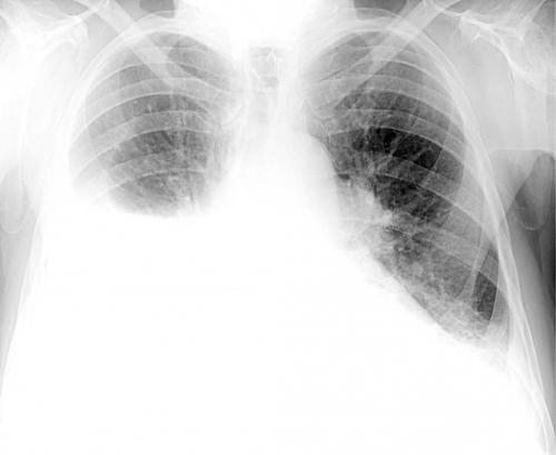 Что такое реабилитация после коронавируса и пневмонии. Изменения в легких при коронавирусе