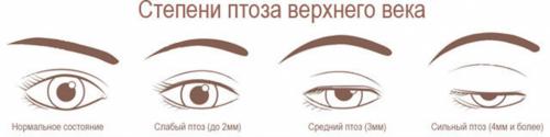 После диспорта веко верхнее опухло. Почему отекают верхние веки после ботокса 01 После диспорта веко верхнее опухло. Почему отекают верхние веки после ботокса 01
