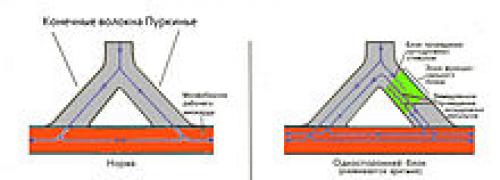 Понимание и управление приступами аритмии: основные принципы и методы 02