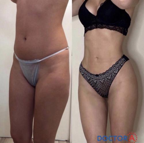 Какой метод удаления жира выбрать. Показания, ограничения, возможности 06