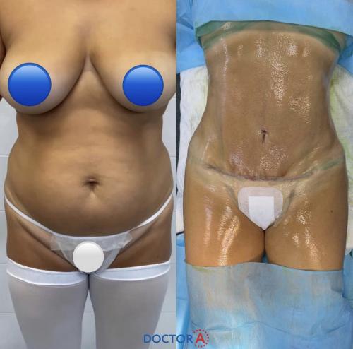 Какой метод удаления жира выбрать. Показания, ограничения, возможности 08