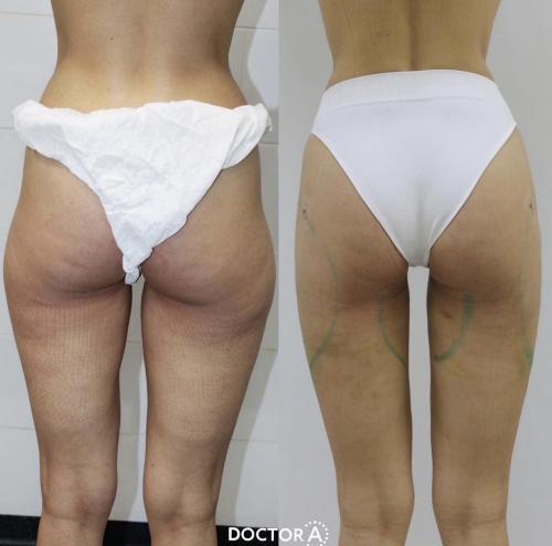 Какой метод удаления жира выбрать. Показания, ограничения, возможности 07