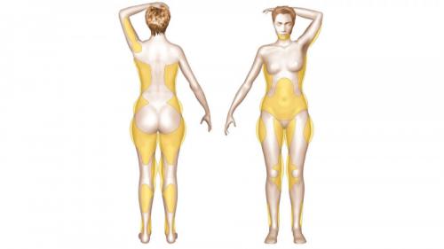 Какой метод удаления жира выбрать. Показания, ограничения, возможности 03