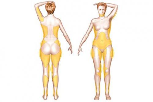 Липосакция жира. Возвращается ли жир после липосакции и сколько длится результат?