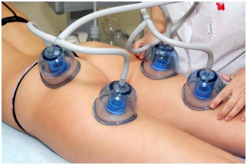 Виды и особенности проведения вакуумного массажа. Вакуумный массаж, как разновидность медицинского массажа 02