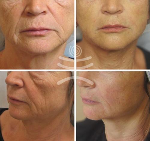 Вакуумно-роликовый массаж с рф лифтингом. Аппаратные процедуры