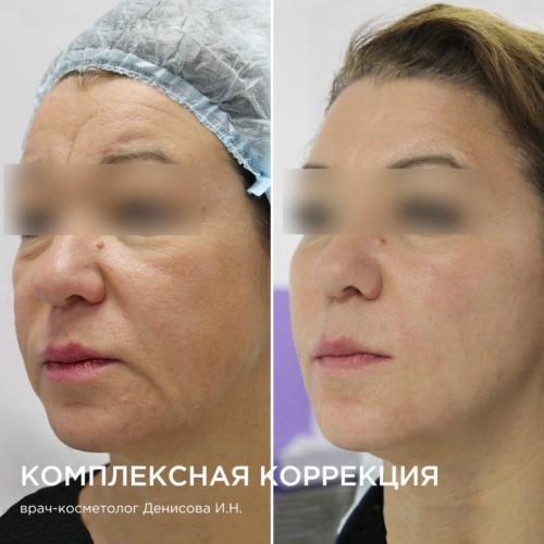 Вакуумно-роликовый массаж с рф лифтингом. Аппаратные процедуры