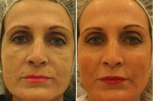 Вакуумно-роликовый массаж с рф лифтингом. Аппаратные процедуры