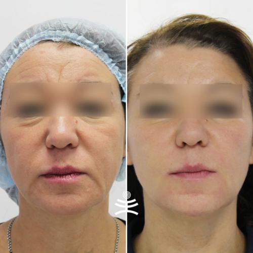 Вакуумно-роликовый массаж с рф лифтингом. Аппаратные процедуры