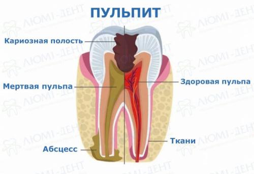 Больно ли лечить пульпит. Больно ли удалять нерв при пульпите?