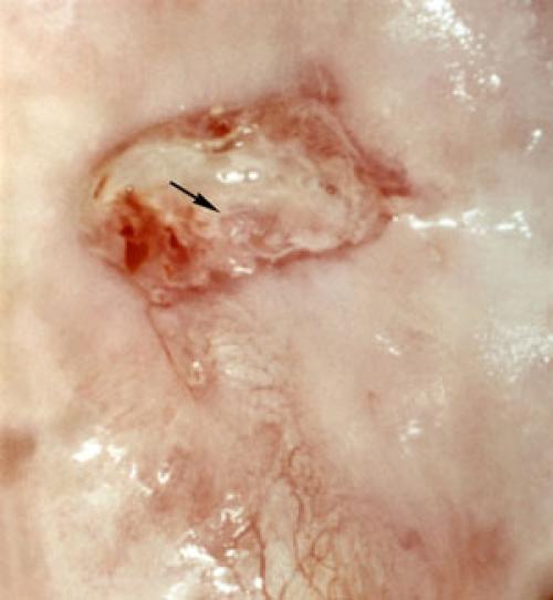 Фото эрозии шейки матки. Симптомы доброкачественных и предраковых заболеваний шейки матки 03 Фото эрозии шейки матки. Симптомы доброкачественных и предраковых заболеваний шейки матки 03