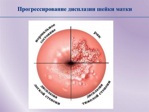 Шейка матки снаружи выстлана многослойным плоским эпителием.. Кольпоскопия шейки матки: нормальная кольпоскопическая картина 01 Шейка матки снаружи выстлана многослойным плоским эпителием.. Кольпоскопия шейки матки: нормальная кольпоскопическая картина 01