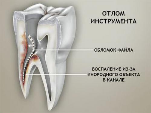 Лечение хронического пульпита по старой цене от 3100 руб. Лечение кариеса: цена 06 Лечение хронического пульпита по старой цене от 3100 руб. Лечение кариеса: цена 06