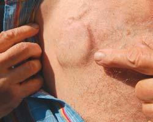 Рекомендации больным с имплантированным кардиостимулятором. Правила поведения на улице и в быту, или жизнь с кардиостимулятором сердца 01