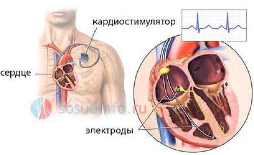 Рекомендации больным с имплантированным кардиостимулятором. Правила поведения на улице и в быту, или жизнь с кардиостимулятором сердца 03