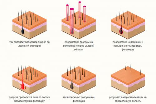 Расшифровка мифа: как быстро вырастают волосы после лазерной эпиляции 01 Расшифровка мифа: как быстро вырастают волосы после лазерной эпиляции 01