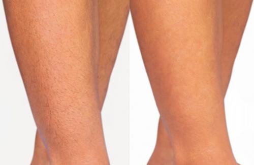 Могут ли волосы вырасти снова после лазерной эпиляции. Среднее время ожидания